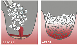 Illustration for article titled This Simple Invention Seals Gunshot Wounds in 15 Seconds Flat
